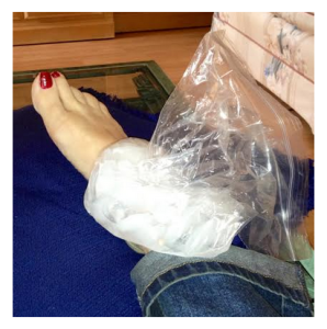 Icing a sprained ankle quelle betise